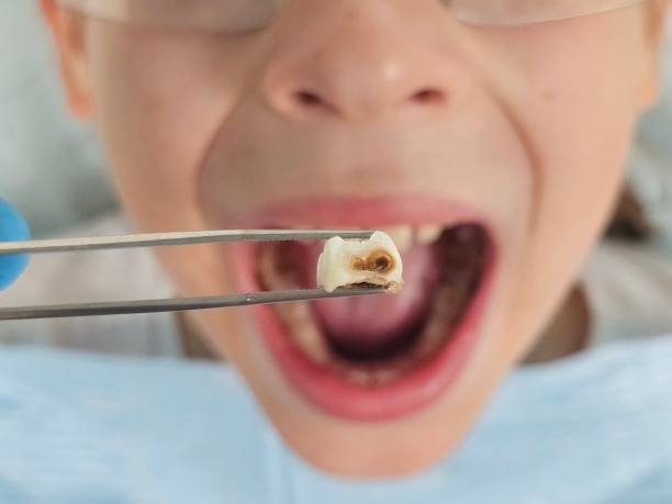 Best Emergency Dental Care for Broken or Chipped Teeth in Winterset, IA