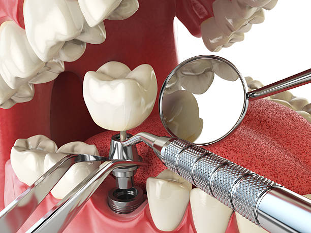 Best Emergency Tooth Extraction in Winterset, IA